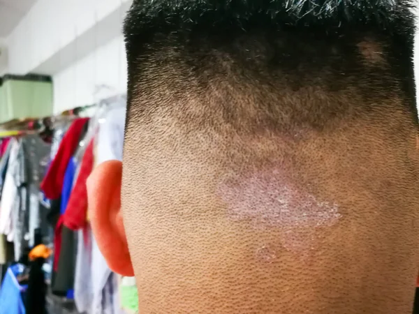 Kafa derisinde tinea olarak da bilinen mantar solucanından kapanmış. Dermatit problemi.