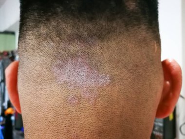 Kafa derisinde tinea olarak da bilinen mantar solucanından kapanmış. Dermatit problemi.