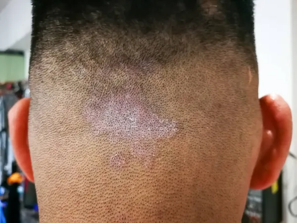 Kafa derisinde tinea olarak da bilinen mantar solucanından kapanmış. Dermatit problemi.