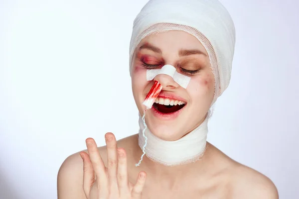 Tampon seseorang di hidung dengan darah terluka wajah close-up — Stok Foto