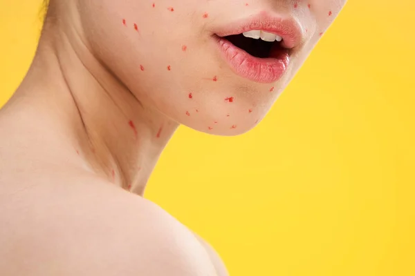 Cara femenina primer plano puntos rojos dermatología erupción — Foto de Stock