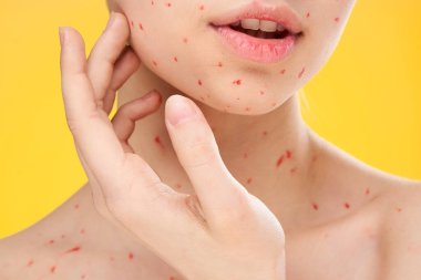 Kadın yüzü yakın çekim kırmızı noktalar cilt döküntüsü