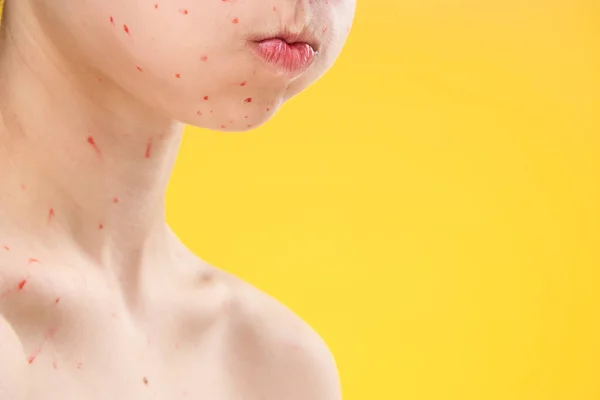 Дерматологическая сыпь на лице женщины крупным планом — стоковое фото