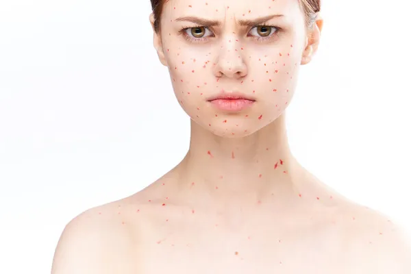 Женщина с красными точками на лице проблемы с кожей кожи дерматологии неудовлетворенность — стоковое фото