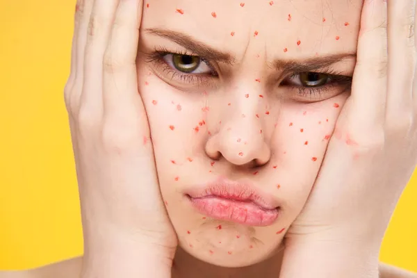 Женщина с красными точками на лице проблемы с кожей кожи дерматологии неудовлетворенность — стоковое фото