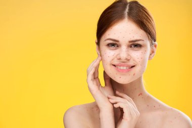 Çıplak omuzlu bir kadın. Yüzünde kırmızı noktalar. Sağlık sorunları.