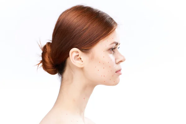 Sad woman with bare shoulders red dots on her face — Stock Photo, Image