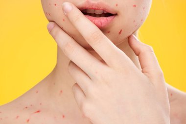 Kadın yüzü yakın çekim kırmızı noktalar cilt döküntüsü