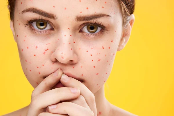 Female face cropped view red dots on the face skin problems — Stock Photo, Image