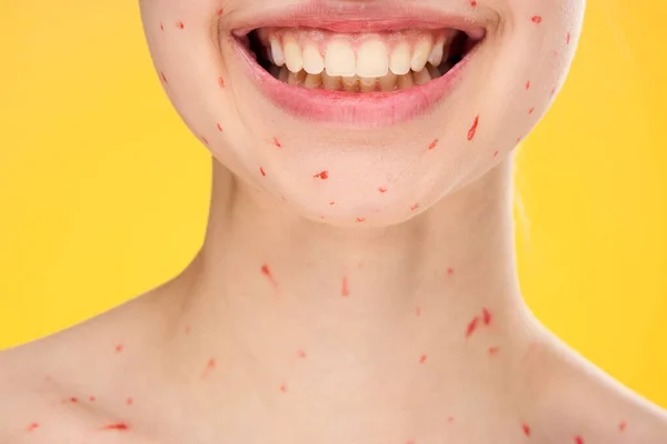 Женское лицо обрезанный вид красные точки на коже лица проблемы — стоковое фото