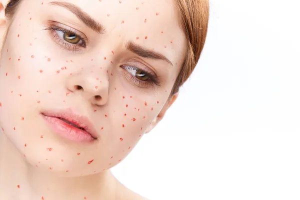 Cheerful woman with bare shoulders dermatology pimples — Stock Photo, Image