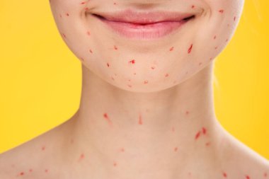 Kadın yüzü, yüz derisindeki kırmızı noktalar ile kırpılmış.