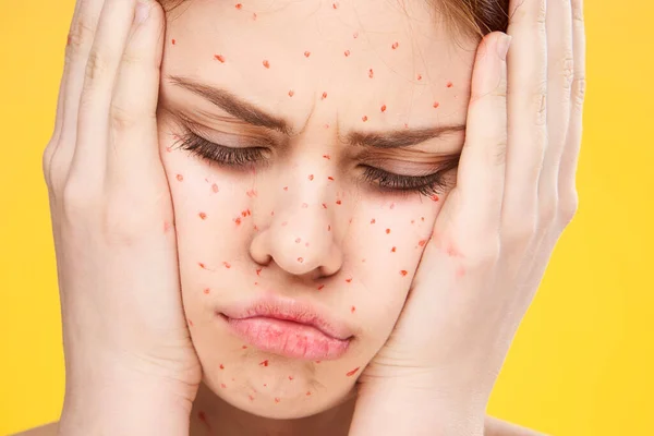 Жінка з червоними крапками на шкірі обличчя проблеми з дерматологією невдоволення — стокове фото