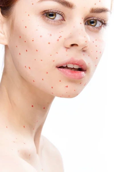 Cheerful woman with bare shoulders dermatology pimples — Stock Photo, Image