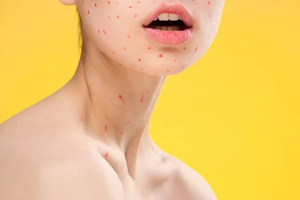 Nainen paljain hartioin punaisia pisteitä hänen kasvonsa terveysongelmia ihotautioppi — kuvapankkivalokuva