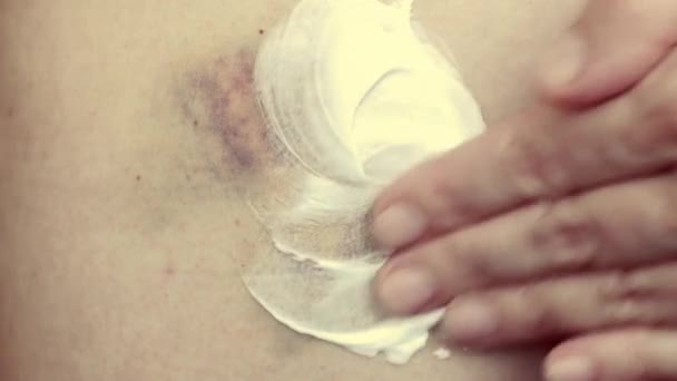 Treatment Hematoma Medicinal Ointment Close Woman Applies Ointment Skin Black — Vídeo de Stock