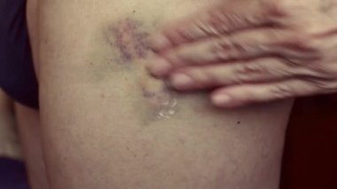 A womans hand rubs a healing cream into a large hematoma on a mans leg. The concept of nursing.