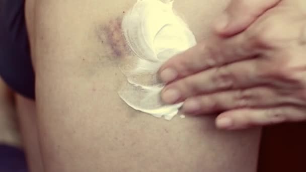 Womans Hand Rubs Healing Cream Large Hematoma Mans Leg Concept — Vídeo de Stock