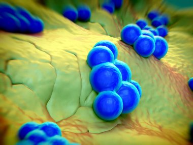 süperböcek veya Staphylococcus aureus (MRSA) bakterisi