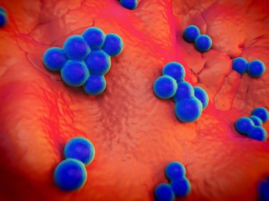 süperböcek veya Staphylococcus aureus (MRSA) bakterisi