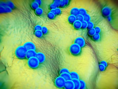 süperböcek veya Staphylococcus aureus (MRSA) bakterisi