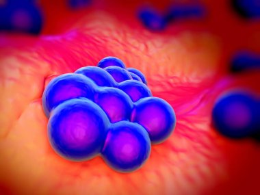 süperböcek veya Staphylococcus aureus (MRSA) bakterisi