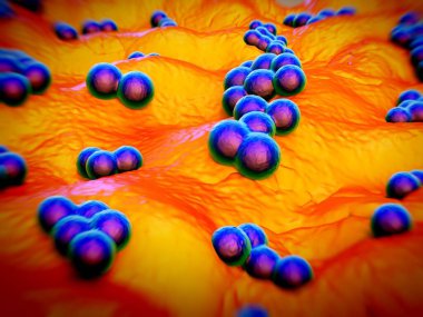 süperböcek veya Staphylococcus aureus (MRSA) bakterisi