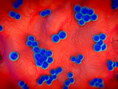 süperböcek veya Staphylococcus aureus (MRSA) bakterisi