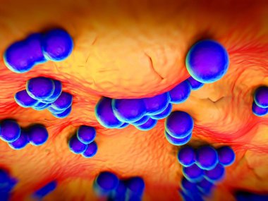 süperböcek veya Staphylococcus aureus (MRSA) bakterisi