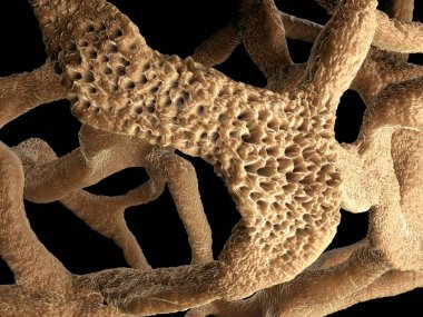 Osteoporotik kemik, sağlıksız kemik yapısı yakın çekim