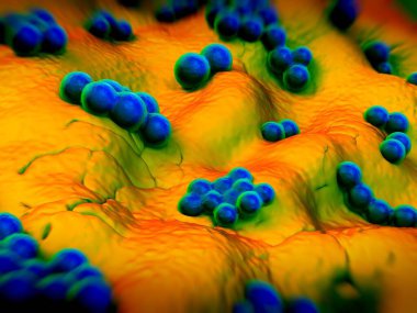 süperböcek veya Staphylococcus aureus (MRSA) bakterisi