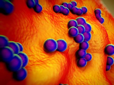 süperböcek veya Staphylococcus aureus (MRSA) bakterisi