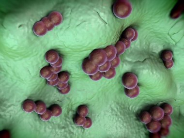 süperböcek veya Staphylococcus aureus (MRSA) bakterisi