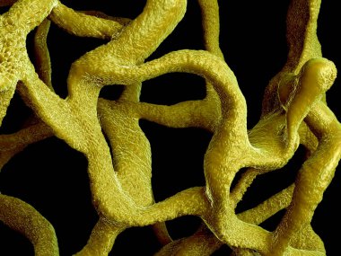 Osteoporotik kemik, sağlıksız kemik yapısı yakın çekim