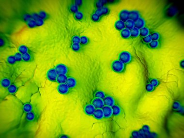 süperböcek veya Staphylococcus aureus (MRSA) bakterisi