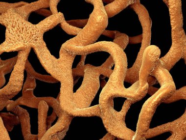 Osteoporotik kemik, sağlıksız kemik yapısı yakın çekim