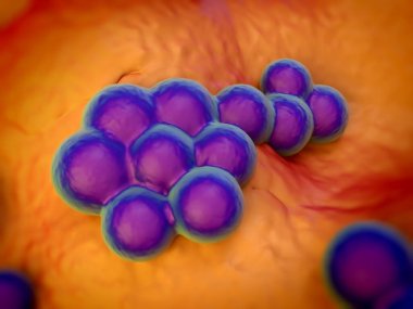 süperböcek veya Staphylococcus aureus (MRSA) bakterisi