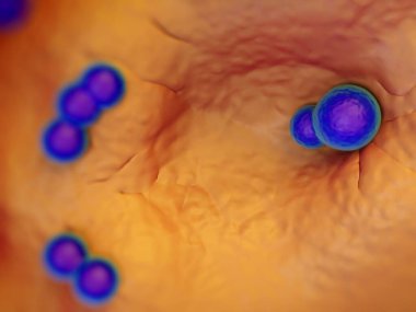 süperböcek veya Staphylococcus aureus (MRSA) bakterisi