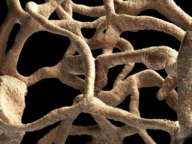 Osteoporotik kemik, sağlıksız kemik yapısı yakın çekim