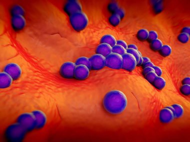süperböcek veya Staphylococcus aureus (MRSA) bakterisi