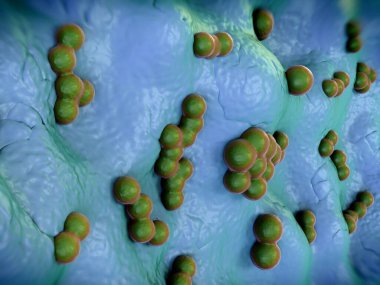 süperböcek veya Staphylococcus aureus (MRSA) bakterisi