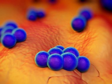 süperböcek veya Staphylococcus aureus (MRSA) bakterisi