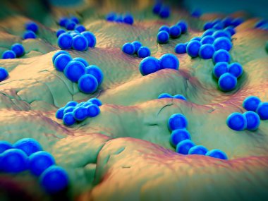 süperböcek veya Staphylococcus aureus (MRSA) bakterisi