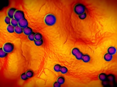 süperböcek veya Staphylococcus aureus (MRSA) bakterisi