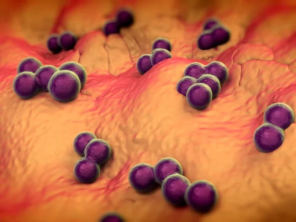 süperböcek veya Staphylococcus aureus (MRSA) bakterisi