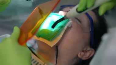 Diş asistanı elleri ultraviyole ışığı ve diş dolgusunu yerleştiren tanımlanamayan bir dişçiyle ayrılıyor. Hastanedeki dişçi koltuğunda hasta tedavi eden beyaz profesyonel kadınlar. Yavaş çekim