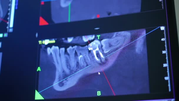 Close Scherm Met Tandheelkundige Beeldvorming Modern Ziekenhuis Binnenshuis Panoramische Röntgenfoto — Stockvideo