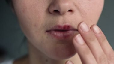 Uçuktan etkilenmiş dudakları olan genç bir kadının yüzü. Parmağı uçuktan etkilenen dudaklara dokunan kız. Acıyor. Güzellik dermatolojisi konsepti.