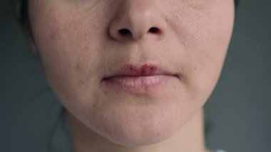 Uçuktan etkilenmiş dudakları olan genç bir kadının yüzü. Parmağı uçuktan etkilenen dudaklara dokunan kız. Acıyor. Güzellik dermatolojisi konsepti.
