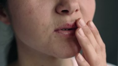 Uçuktan etkilenmiş dudakları olan genç bir kadının yüzü. Parmağı uçuktan etkilenen dudaklara dokunan kız. Acıyor. Güzellik dermatolojisi konsepti.